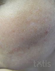Результати 01 Me Line Caucasian Skin  фото после #2