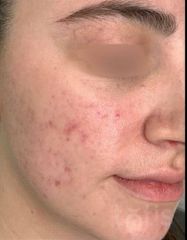 Результати Beta Gel with 10% Glycolic Acid  фото после #2