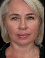 Rezultate Facetem S 0.8ml * 1 seringă  фото до #1