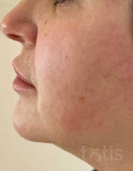 Результати Набір TESSLIFT SOFT V-DERM (10 ниток) + Бандаж + канюля SoftFil 18G 70mm + 18G*40mm голка  фото до #1
