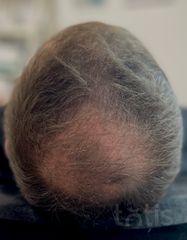 Результаты HAIR LOSS CONTROL  фото после #2
