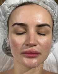 Результати 3080 [SKIN] BIOSIS PROFESSIONAL MASK  фото после #2