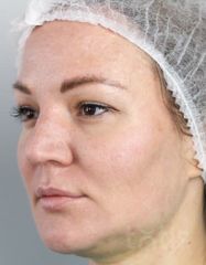 Результати Набір TESSLIFT SOFT V-DERM (10 ниток) + Бандаж + канюля SoftFil 18G 70mm + 18G*40mm голка  фото после #2