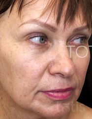 Результати Facetem S 1,5 ml  фото до #1