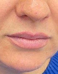 Результати Saypha Filler Lidocaine NEW  фото до #1
