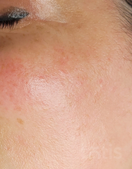 Результаты Sensicura Regeneration Cream  фото после #2