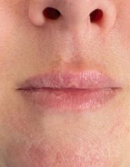 Результати Saypha Filler Lidocaine NEW  фото до #1