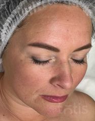 Результаты 640 Lift'Expert Serum  фото до #1