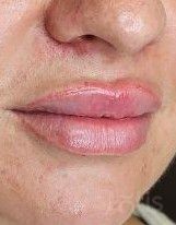 Результати Saypha Filler Lidocaine NEW  фото после #2