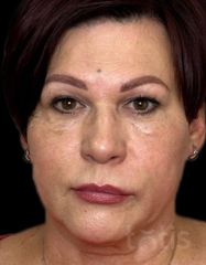 Rezultate Facetem S 0.8ml * 1 seringă  фото до #1