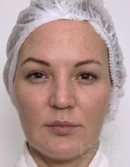 Результаты Набор TESSLIFT SOFT V-DERM (10 нитей) + Бандаж + канюля SoftFil 18G 90mm + 18G*40mm игла  фото до #1