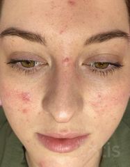 Результаты PURE Acne Cream  фото после #2