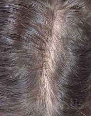 Результати Plinest Hair  фото после #2