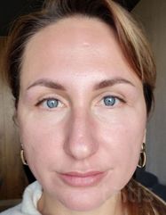 Результаты Lactic Astringent Prepping Agent  фото после #2