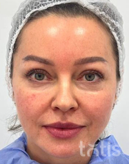 Rezultaty Zestaw TESSLIFT SOFT V-DERM (10 nici) + Bandaż + kaniula SoftFil 18G 70mm + igła 18G  фото до #1