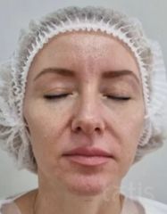 Výsledky Facetem S 0.8mlx2  фото до #1