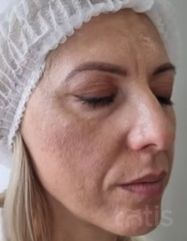 Результати Facetem S 1,5 ml  фото до #1