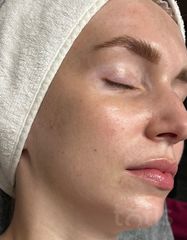 Результаты 540 Lumin’Éclat Enhancing Serum  фото после #2