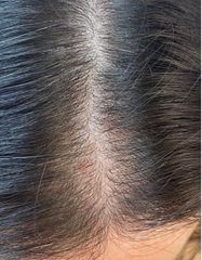 Результати Plinest Hair  фото после #2