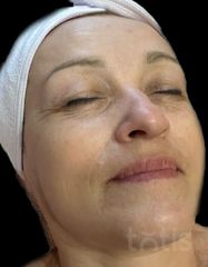 Результаты Collagen Fleece Mask Fruit Acid  фото до #1