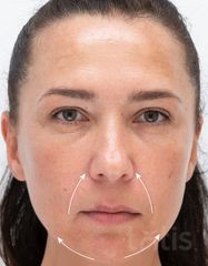 Výsledky Facetem S 0.8mlx2  фото после #2