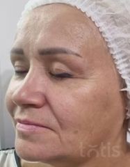 Результати Facetem S 1,5 ml  фото до #1