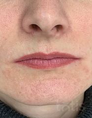 Результати Saypha Filler Lidocaine NEW  фото до #1