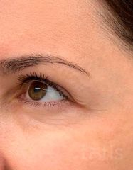 Результаты ULTIMATE EYE CORRECTOR  фото после #2