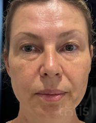 Результаты Набор TESSLIFT SOFT V-DERM (10 нитей) + Бандаж + канюля SoftFil 18G 90mm + 18G*40mm игла  фото после #2