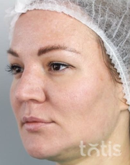 Rezultaty Zestaw TESSLIFT SOFT V-DERM (10 nici) + Bandaż + kaniula SoftFil 18G 70mm + igła 18G  фото после #2