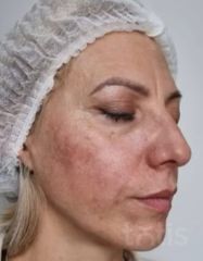 Результати Facetem S 1.5ml *1 шт. + конектор  фото после #2