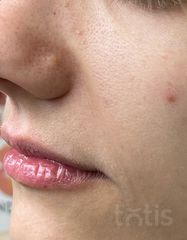 Результаты 650 Lift'Expert Wrinkle Smoother  фото после #2