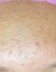 Результати AKN βPURIFIER NIGHT GEL  фото до #1