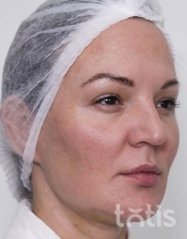 Rezultaty Zestaw TESSLIFT SOFT V-DERM (10 nici) + Bandaż + kaniula SoftFil 18G 70mm + igła 18G  фото до #1