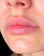 Результати Saypha Filler Lidocaine NEW  фото до #1