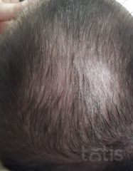 Результати XTRA HAIR RESTORER LOTION  фото после #2