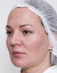 Результати Набір TESSLIFT SOFT V-DERM (10 ниток) + Бандаж + канюля SoftFil 18G 70mm + 18G*40mm голка  фото до #1