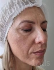Výsledky Facetem S 0.8mlx2  фото до #1