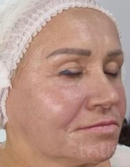 Результати Facetem S 1.5ml *1 шт. + конектор  фото после #2
