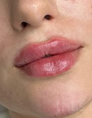 Результати Saypha Filler Lidocaine NEW  фото после #2