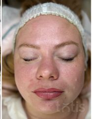 Результаты Professional Peptide Perfection Exfoliator  фото после #2