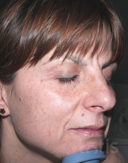 Результати 01 Me Line Caucasian Skin  фото после #2