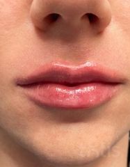Результати Saypha Filler Lidocaine NEW  фото после #2