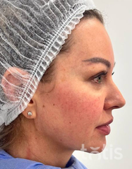 Rezultaty Zestaw TESSLIFT SOFT V-DERM (10 nici) + Bandaż + kaniula SoftFil 18G 70mm + igła 18G  фото до #1