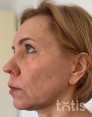 Rezultaty Zestaw TESSLIFT SOFT V-DERM (10 nici) + Bandaż + kaniula SoftFil 18G 70mm + igła 18G  фото после #2