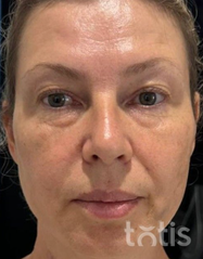 Rezultaty Zestaw TESSLIFT SOFT V-DERM (10 nici) + Bandaż + kaniula SoftFil 18G 70mm + igła 18G  фото после #2