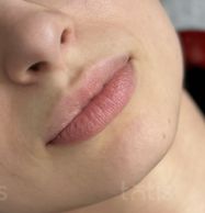 Результати Saypha lips Lidocaine  фото до #1