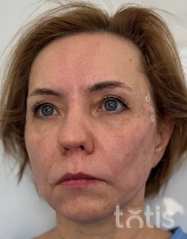 Rezultaty Zestaw TESSLIFT SOFT V-DERM (10 nici) + Bandaż + kaniula SoftFil 18G 70mm + igła 18G  фото после #2