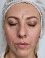Rezultate Facetem S 0.8ml * 1 seringă  фото после #2