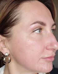 Результати Professional Peptide Perfection Exfoliator  фото после #2
